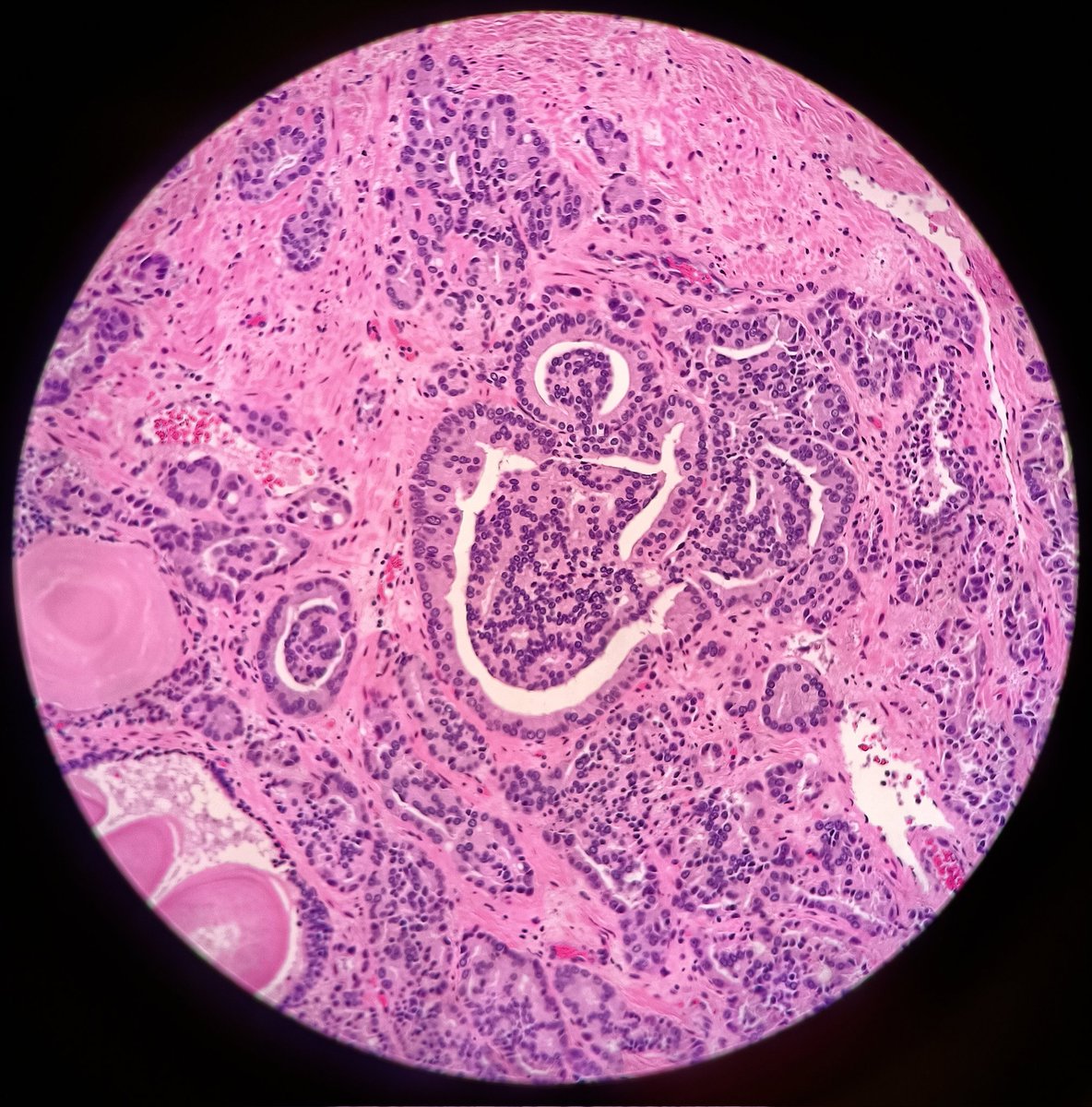 It's not a kidney and it's not a glomerulous! Where is this cute glomeruloid pattern from? #GUpath