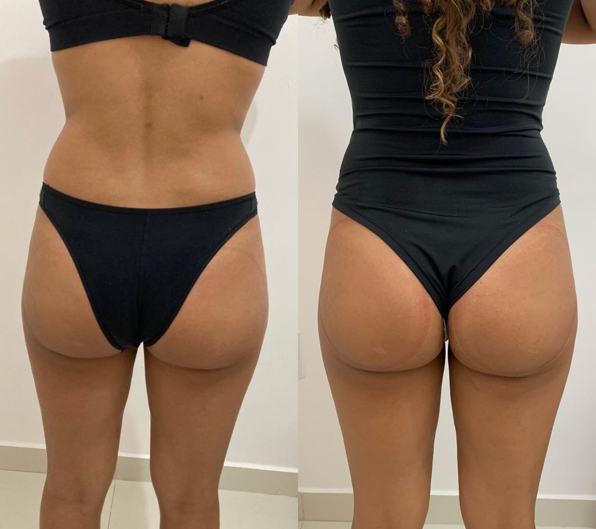 esteticdanicost's tweet photo. Pois se você não teve tempo de malhar esse ano, ou at�� malhou mas ainda não conseguiu o resultado que desejava… EU VIM TE SALVAR, MULHER!
Mas antes, já compartilha isso com sua amiga para vocês duas arrasarem de biquíni, como essa minha cliente da foto. https://t.co/UOdQ9mpZDQ