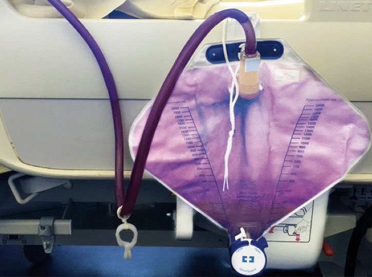 AvrahamCooperMD's tweet photo. Why does this patient have purple urine?

#MedTwitter https://t.co/F6Gjr6HIKC