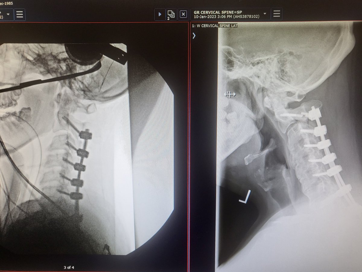 Medical update,  since the accident in September,  you can see the 2 snapped screws,  as well as that section of the vertebrae has shifted forward and is no longer stable.  Frustrating part of recovery but we will get through this.
