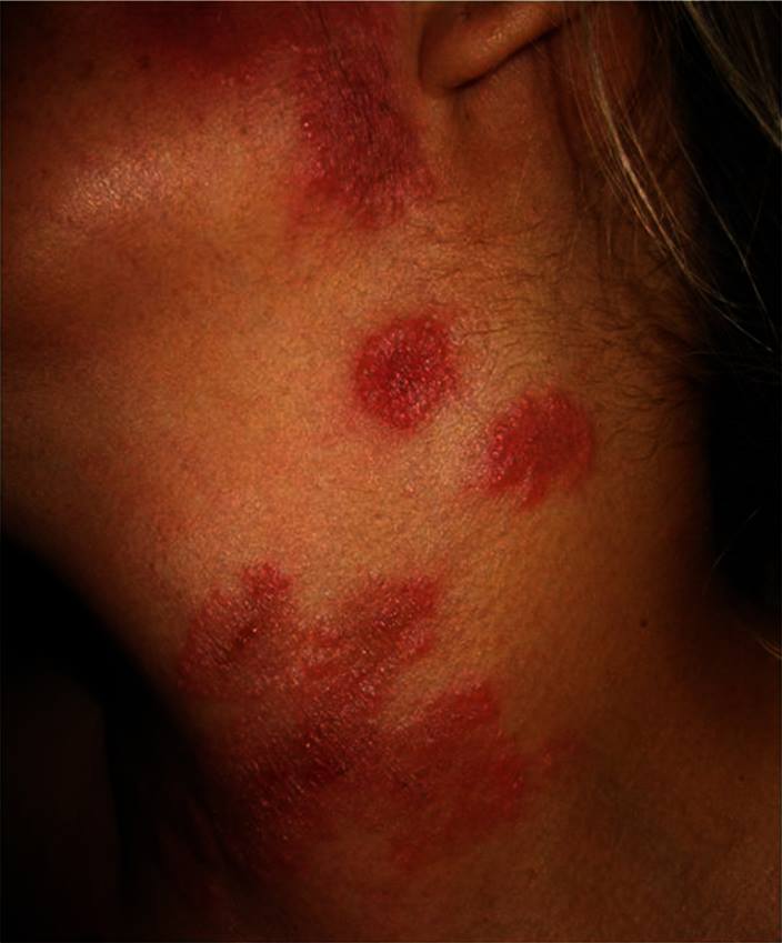 pr_enarm's tweet photo. Femenina de 35 años con antecedente de artritis reumatoide , acude a consulta x fatiga, fiebre y presenta estas lesiones en cuello y dorso de la mano
Decide realizarle biopsia encontrando dermatitis neutrofilica https://t.co/XlKr3oPr5f