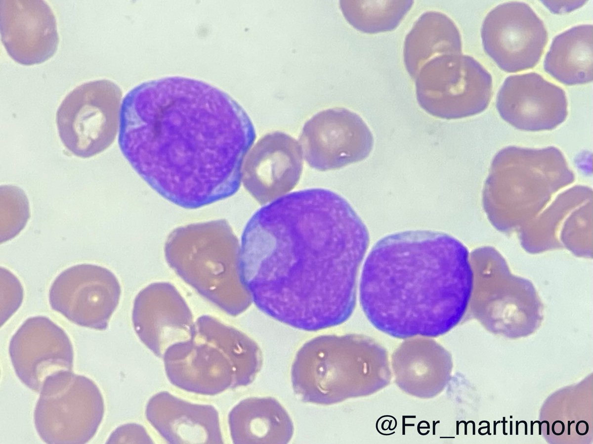 Fer_martinmoro's tweet photo. Old female presented with fatigue and fevers at the ER. CBC revealed de novo Hb 7 g/dL, platelets 30,000/uL and WBCs 70,000/uL. Blood smear is performed and showed 🔬 

What is your diagnosis? Any genetic alteration suspected? 

#cytopath #PathTwitter https://t.co/uxqNcrS3PJ