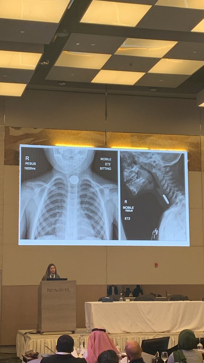 Dr. Leena Amin: ingestion of button batteries is an indication to call your gastroenterologist for endoscopy #MENATOX2023