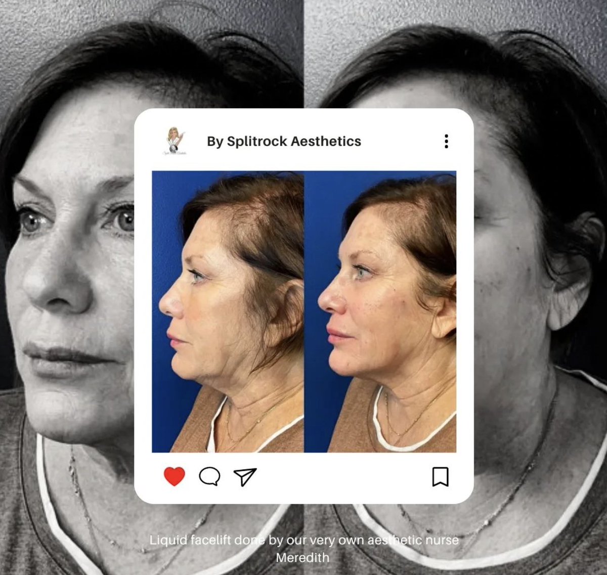 SplitRockAesIns's tweet photo. What can properly placed filler do for you? Check THIS out.

#liquidfacelift #fillers #beautifulfaces #ctmedspa #medspact #injector #lipfiller #botox #beauty #aesthetics #injectables #fillers #lips #dermalfillers #juvederm #lipinjections #injections #skincare #antiaging https://t.co/CMHQYztATe