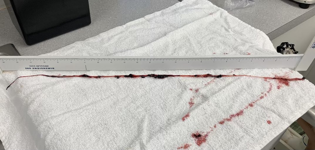 DiedSuddenly_'s tweet photo. BREAKING NEWS: 

Our local embalmer (who was initially skeptical of the #Diedsuddenly Film) sent us this photo today. 

He was horrified — finding his first round of fibrous clots in the vaxxed dead. 💉

The clot that he pulled from the body was 16 inches long. https://t.co/Daskvr7t0k