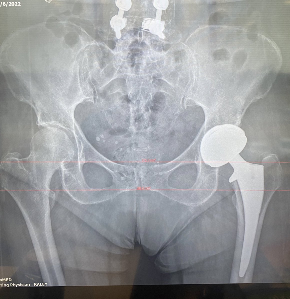 jraley440's tweet photo. @jointdocShields You can fit the actis 0 in almost anything https://t.co/nyDdWErY2T