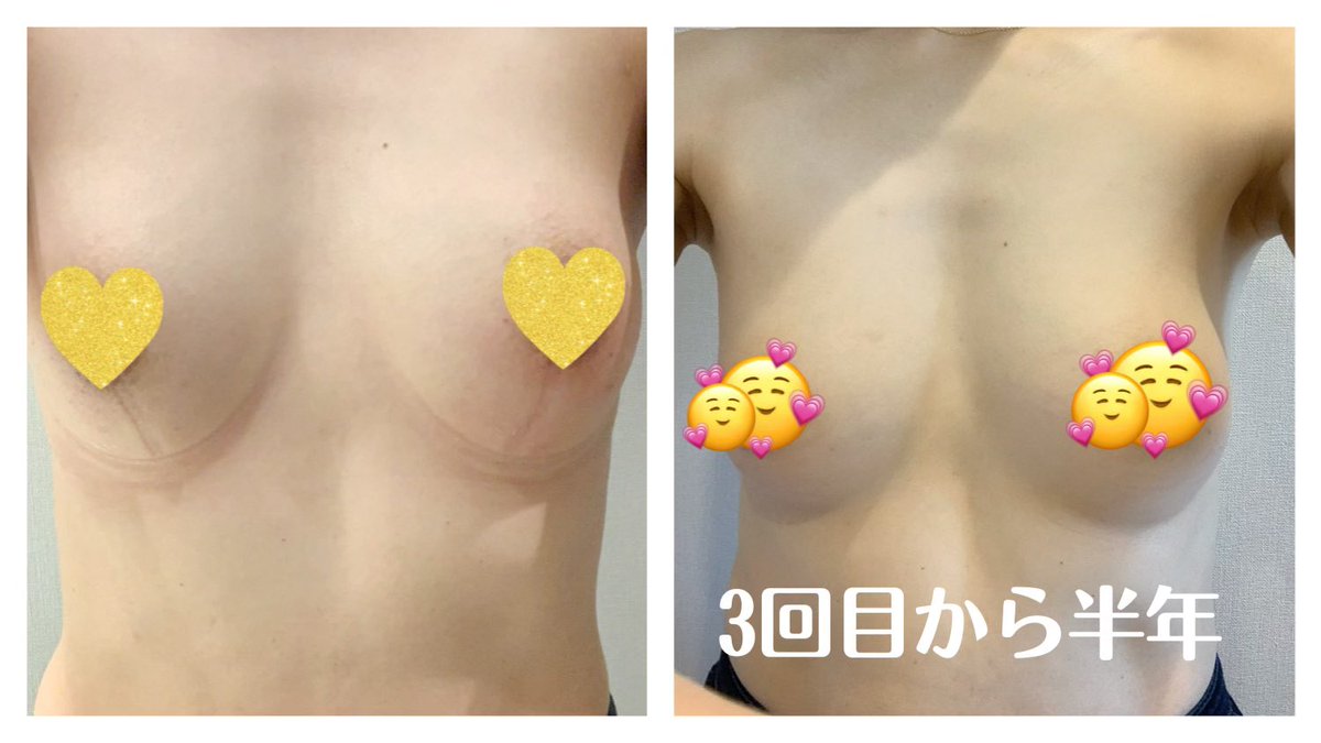 workingmom008's tweet photo. 3回目１週間後→半年以上。施術後って大きくなって嬉しいけど、時間が経った今の形が気に入っている。小さくなったと気になる方へのご参考🎵
#脂肪再生豊胸 https://t.co/ZbFJHonH8X