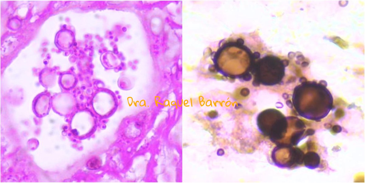 12-year-old boy PARACOCCIDIODOMYCOSIS (South American Blastomycosis) ◦🔬 Large, round yeast cells with multiple narrow-based, budding yeasts (ship's wheel appearance) ◦Granulomatous inflammation #PathTwitter #path #fungal
