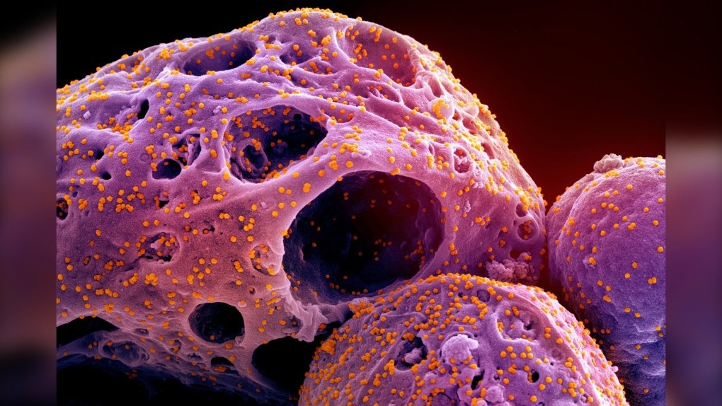 61_bullet's tweet photo. @Dylan_Maximoff_ @RobertPortwoo14 @PFleeceman COVID is the leading cause of death in children. 

I can not fathom why the truth of what this disease does is ignored.

This is what having COVID is. The pink blobs are individual CELLS. The orange dots are COVID. 

COVID eats cells. To start. https://t.co/zHliPg9tMf
