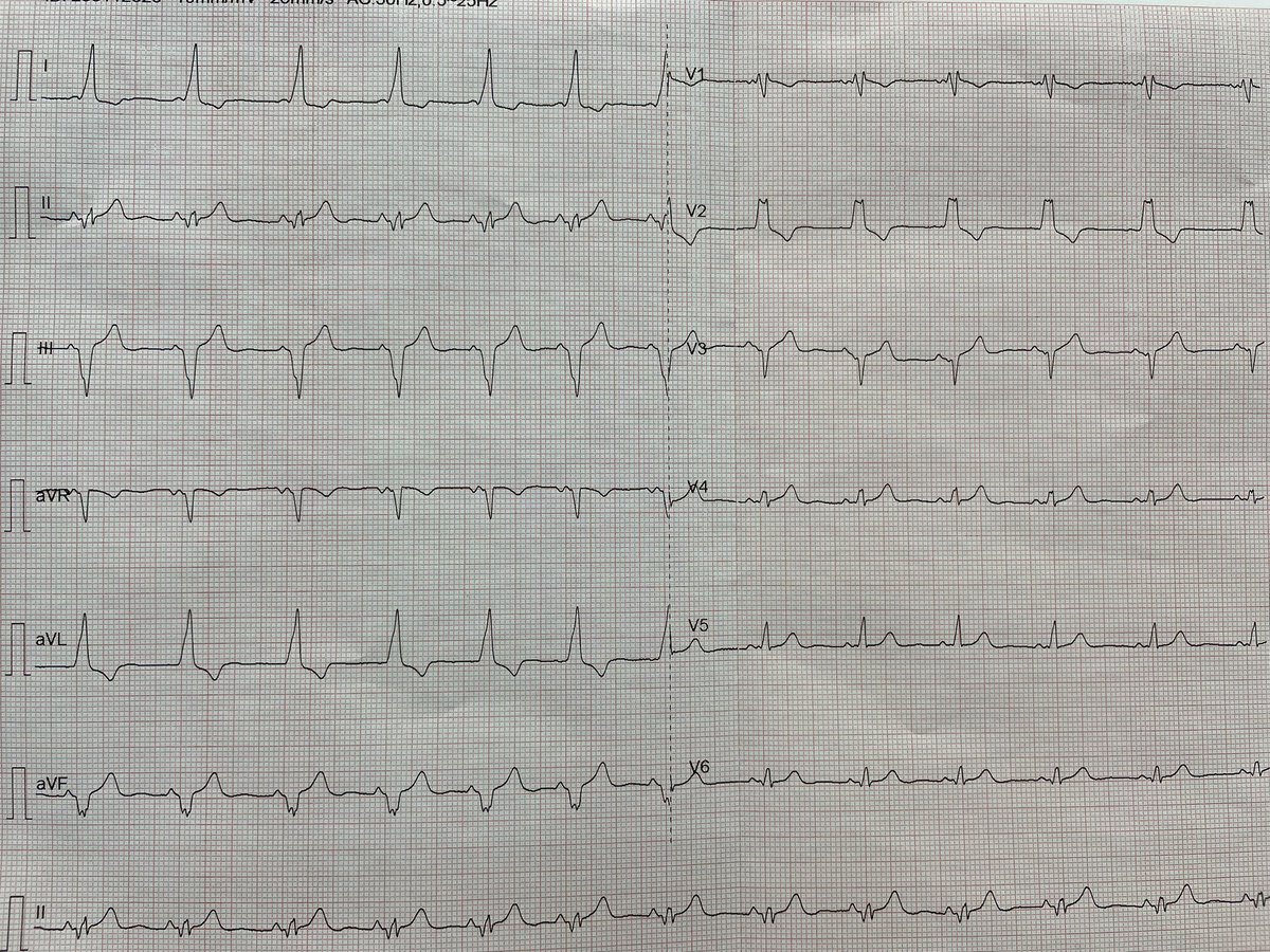 Mujer 20 años. Episodios semanales de palpitaciones desde hace 6 meses. Inicio brusco, rápidas y rítmicas, bien toleradas, duran minutos. Ceden con tos. No ha dado tiempo a ECG . Ecocardiograma normal. Cual crees que puede ser la causa más probable?