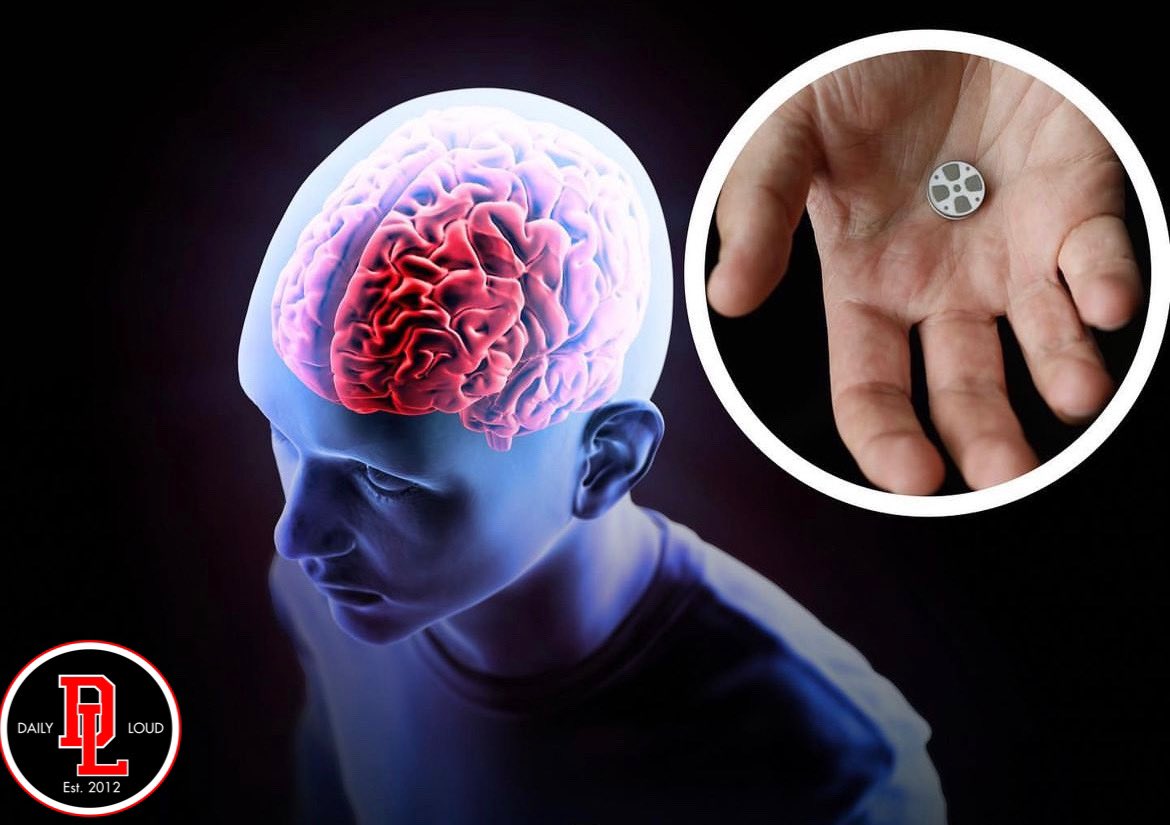 Worlds first brain implant to treat depression begins 2nd human trial. Moving one step closer to being available to the public.