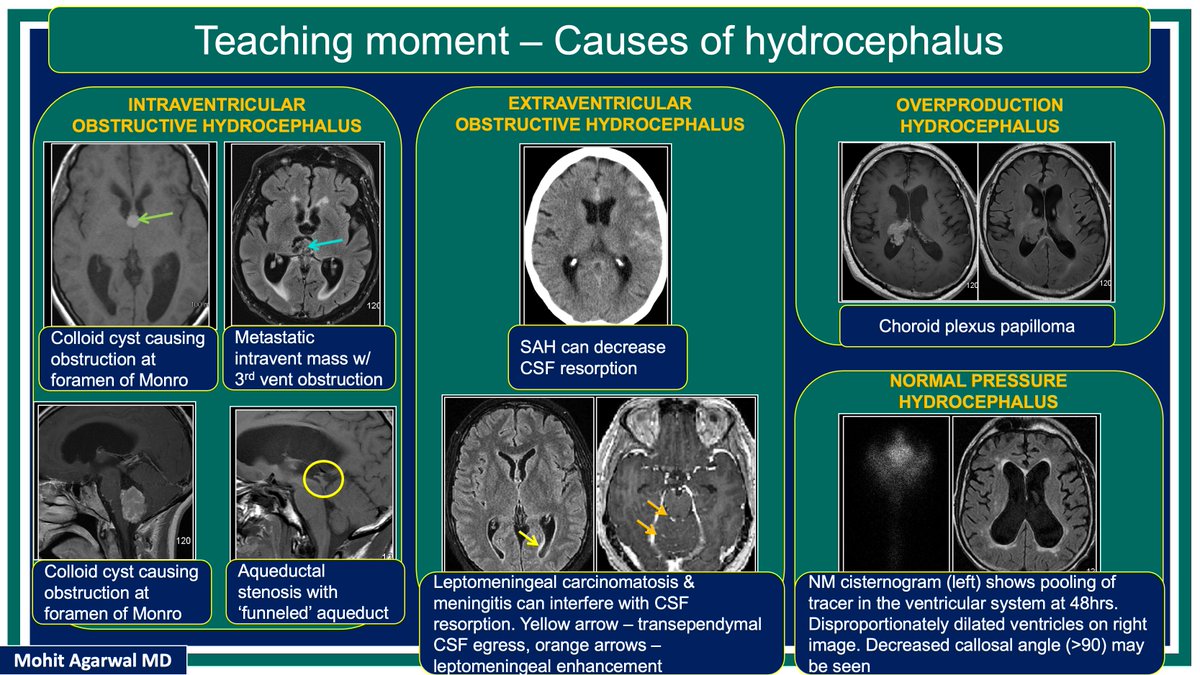 @X (@publishedxprime) on Twitter photo #MCWNeuroradBTW 093 Ans:Extravent hydrocephalus
Check out #TeachingMoment on Hydrocephalus
#FOAMed #radres #MedEd <a href="/TheASNR/">The American Society of Neuroradiology</a> <a href="/ARRS_Radiology/">ARRS</a> <a href="/BSHNI_UK/">British Society of Head & Neck Imaging</a> <a href="/ESNRad/">ESNR</a> <a href="/BshniTrainees/">BSHNI Trainees</a> <a href="/ESNRad/">ESNR</a> <a href="/bdoop3210/">Brian Dupree</a> <a href="/MCWNeurorad/">MCW Neuroradiology</a> <a href="/AwanRad/">Omer Awan MD MPH</a> <a href="/aaronrutman/">Aaron Rutman, MD</a> <a href="/ShivaprakashBH4/">Shivaprakash B. Hiremath</a> <a href="/drSurjthVattoth/">Surjith Vattoth</a> <a href="/RamVaidhyanath/">Ram Vaidhyanath</a> #MCWNeuroradBTW 093 Ans:Extravent hydrocephalus
Check out #TeachingMoment on Hydrocephalus
#FOAMed #radres #MedEd <a href="/TheASNR/">The American Society of Neuroradiology</a> <a href="/ARRS_Radiology/">ARRS</a> <a href="/BSHNI_UK/">British Society of Head & Neck Imaging</a> <a href="/ESNRad/">ESNR</a> <a href="/BshniTrainees/">BSHNI Trainees</a> <a href="/ESNRad/">ESNR</a> <a href="/bdoop3210/">Brian Dupree</a> <a href="/MCWNeurorad/">MCW Neuroradiology</a> <a href="/AwanRad/">Omer Awan MD MPH</a> <a href="/aaronrutman/">Aaron Rutman, MD</a> <a href="/ShivaprakashBH4/">Shivaprakash B. Hiremath</a> <a href="/drSurjthVattoth/">Surjith Vattoth</a> <a href="/RamVaidhyanath/">Ram Vaidhyanath</a>