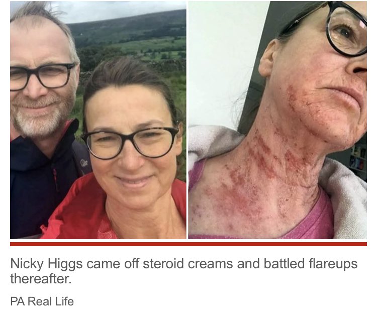 topicaldebate's tweet photo. @PSCommissioner @chat2sonia @jade_ackers @hsib_org @NHSEngland @DHSCgovuk Hope you covered #TopicalSteroidWithdrawal as this is
#MedicallyInduced
#Preventable
#Criminal
#Suffering is #FullBody & #TimeScale for #Recovery unknown.
Drs are #FullyAware these #Drugs are responsible but clearly #Money over #Morals rules #BigPharma #KickBacks. #HelpUs https://t.co/KLa96WMcAP