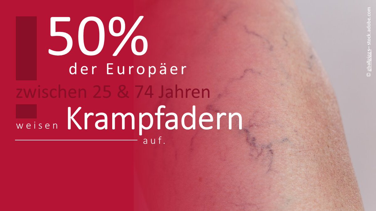 DGG_Tweets's tweet photo. Was sind eigentlich Krampfadern?🧐Eine #Krampfader (Varize) ist eine geschlängelte, erweiterte und in ihrer Funktion gestörte Vene. Eine wesentliche Ursache für dieses Krankheitsbild ist die ererbte #Bindegewebsschwäche mit Schwächung der Venenwand und der Venenklappen. https://t.co/RATtZin7kL