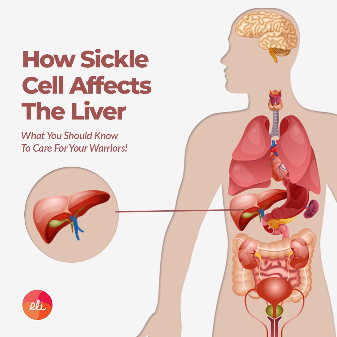 How Sickle Cell affects the liver.

What you should know to care for your warriors. 

👇🏽👇🏽👇🏽

#TheEliApp #TechMeetsHealth #StopThePain #SickleCellApp #LiverProblems #ChildrensHealth #LivingWithSickleCell