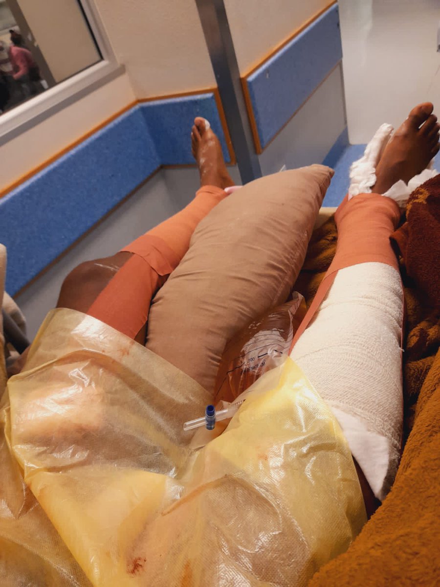 NoEyebrows's tweet image. 21 September 2022 around 4pm two guys came into my house pointed me with a gun and asked for my car keys and i gave them, they wanted to tie when i refused the shot me 7 bullets broke both my legs. And since that day its been operation after operation.