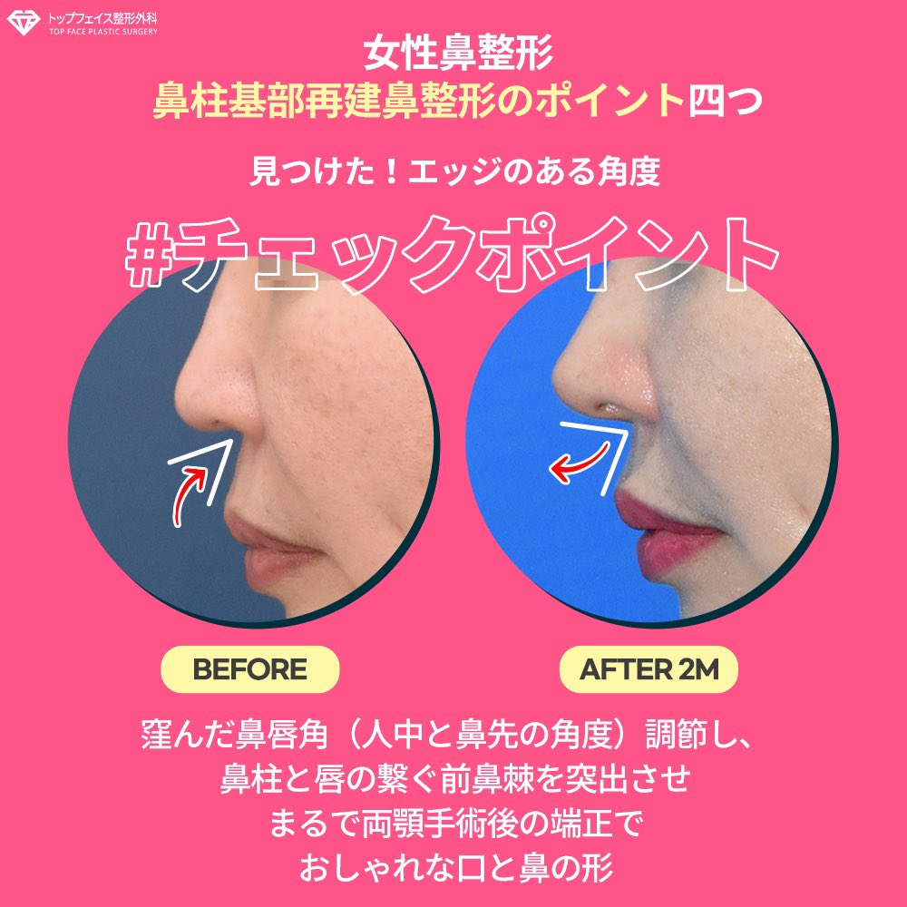 nkmrune's tweet photo. Before After
元々、顔の左右差があり右側が小さい(歪んでる？)です😢
写真でも少し歪んでるように見えますが、失敗等ではなく「生まれつき」です🙇‍♀️ご安心ください。
又、横顔を見ていただくと口元がスッキリしてるのが分かるかと思います😭
#TOPFACE #トップフェイス https://t.co/q0Dm5dpzWW