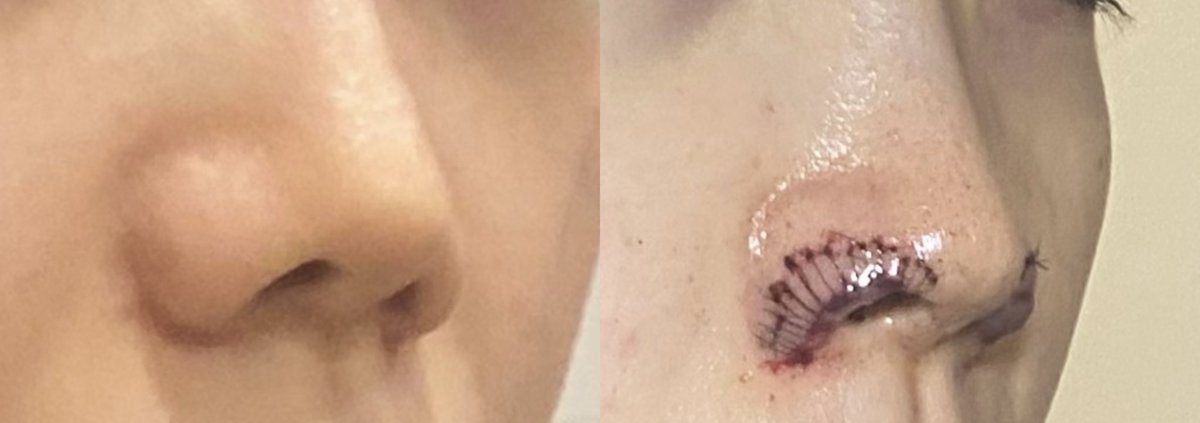 face_cmp's tweet image. 鼻孔縁挙上当日

パンパンに小鼻腫れてるし軟膏で見にくいけどどう見ても鼻翼爆上がりしてて嬉しい😭❤️

軟膏で傷口覆わないといけないんだけどこの商品が適役だった
オペ控えてる人は買っておくのおすすめ❣️