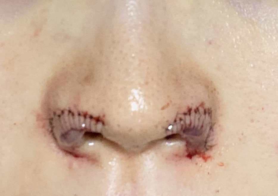 face_cmp's tweet image. 鼻孔縁挙上当日

パンパンに小鼻腫れてるし軟膏で見にくいけどどう見ても鼻翼爆上がりしてて嬉しい😭❤️

軟膏で傷口覆わないといけないんだけどこの商品が適役だった
オペ控えてる人は買っておくのおすすめ❣️