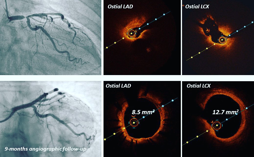 NSTEMI due to subtotal 1:1:1 LM Bifurcation stenosis. Cut &amp; crack (Wolverine &amp; OPN): stent LM to LAD, drug coated balloon ostial LCX! Planned angiographic follow up at 9 months. What are your thoughts?