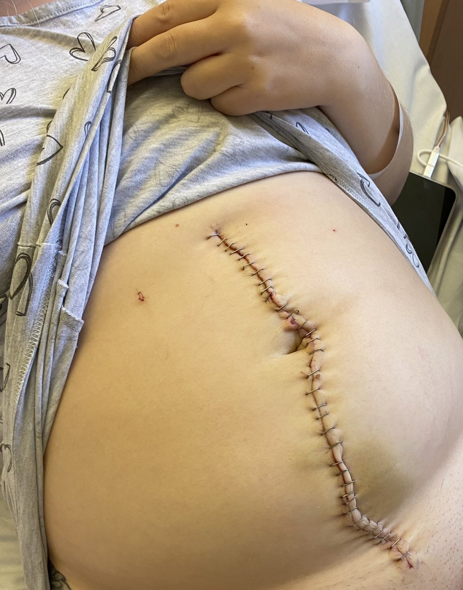 EmmaColledge's tweet image. When I say I owe my life to the amazing surgeons at the @Gateshead_NHS  at the QE is ridiculous! They’ve done such amazing work on me and have supported me! Get to know the symptoms of ovarian cancer. I’m back living life like I would normally 🫶🏽 #ovariancancer #ovarian