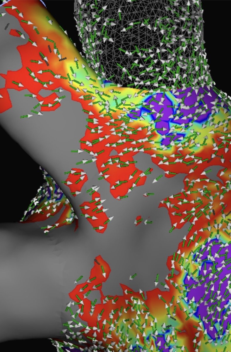 Cristina Donofrio (@cgdonofrio) on Twitter photo Redo AFib. #HDGrid and #OT used to clearly identify and ablate PV reconnections. Great first VoXel Case on Ensite X with <a href="/HanyDemo/">Hany Demo, MD, FACC, FHRS</a>
#OnlyWithOT #MidAmericaEP #HDGrid <a href="/AbbottCardio/">Abbott Cardiovascular</a> Redo AFib. #HDGrid and #OT used to clearly identify and ablate PV reconnections. Great first VoXel Case on Ensite X with <a href="/HanyDemo/">Hany Demo, MD, FACC, FHRS</a>
#OnlyWithOT #MidAmericaEP #HDGrid <a href="/AbbottCardio/">Abbott Cardiovascular</a>