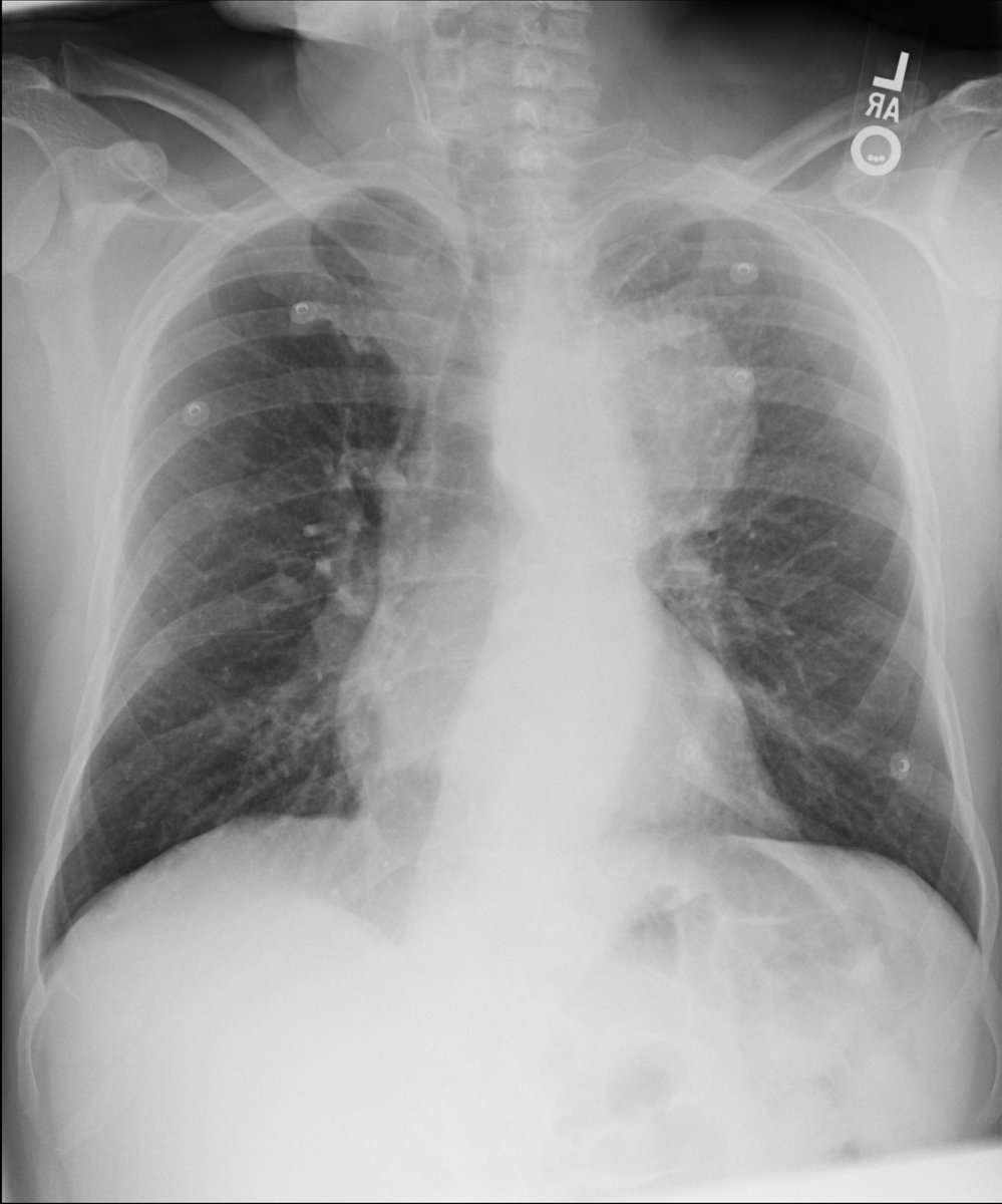 BIDMC Musculoskeletal Imaging & Intervention (@bidmc_mskimg) on Twitter photo 🚀 It's time for Case # 113 <a href="/BIDMC_MSKImg/">BIDMC Musculoskeletal Imaging & Intervention</a>!
➡️ History withheld.
📅 Let us know your diagnosis by Friday, Jan. 20!
#Radiology #MSKRad #MedTwitter #CaseOfTheWeek
<a href="/JimWuMSK/">Jim Wu</a> <a href="/SDeshmukh_MD/">SwatiDeshmukh,MD</a> 🚀 It's time for Case # 113 <a href="/BIDMC_MSKImg/">BIDMC Musculoskeletal Imaging & Intervention</a>!
➡️ History withheld.
📅 Let us know your diagnosis by Friday, Jan. 20!
#Radiology #MSKRad #MedTwitter #CaseOfTheWeek
<a href="/JimWuMSK/">Jim Wu</a> <a href="/SDeshmukh_MD/">SwatiDeshmukh,MD</a>