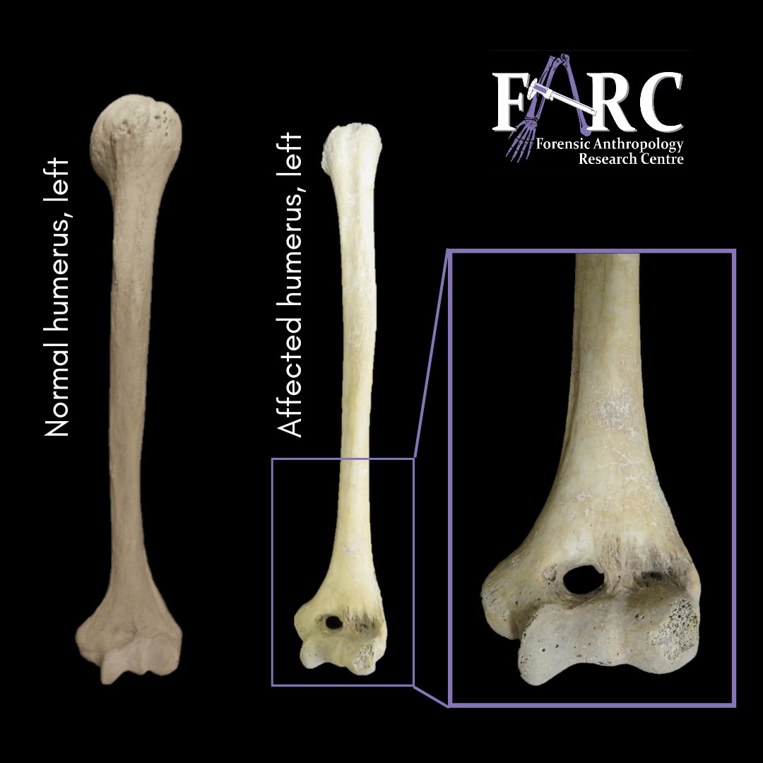 UPAnthro's tweet photo. #wtFARCfriday 
In anatomy, a foramen is an opening in a bone that allows nerves and blood vessels to pass through. While there are numerous foramen present in the human skeleton, some individuals will have additional foramina in certain bones thanks to #humanvariation https://t.co/UJZxvxobQF