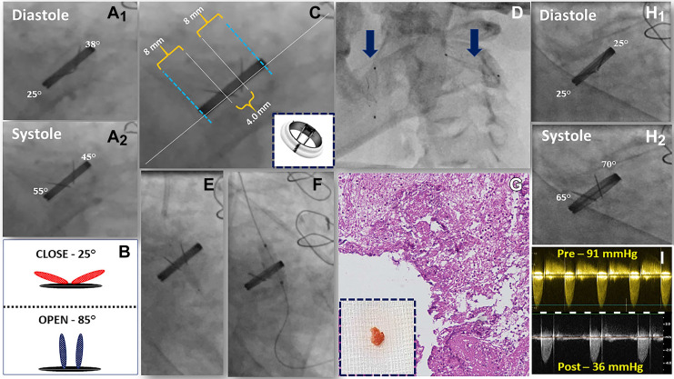 Transcatheter release of a stuck mechanical aortic valve with #CerebralEmbolicProtection 📰➡️ doi.org/10.1016/j.jsca… @Nandha_Vasu @MohammedQintar @PedroMDMSc @KAlaswadMD