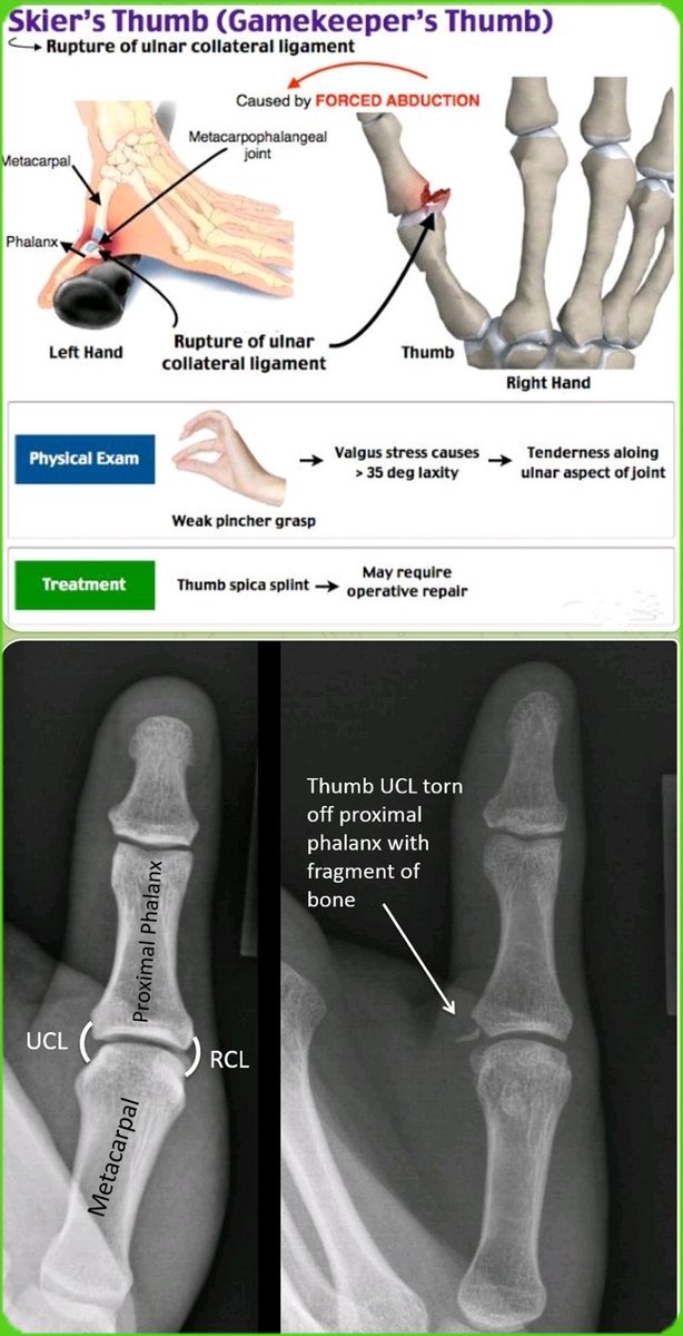 Dr.OMID BANDARCHI ,M.D. on Twitter "Skier's thumb is an injury to