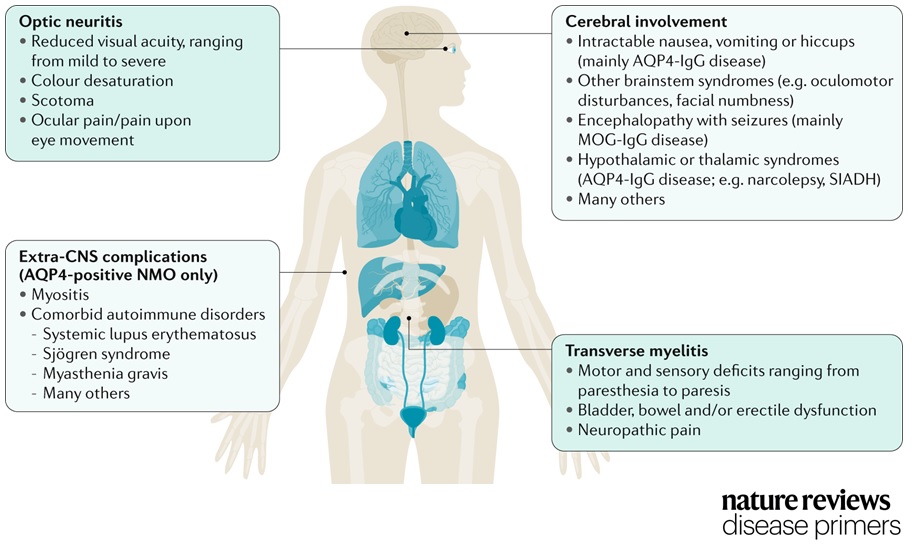 Nature Reviews Disease Primers On Twitter Neuromyelitis Optica Is