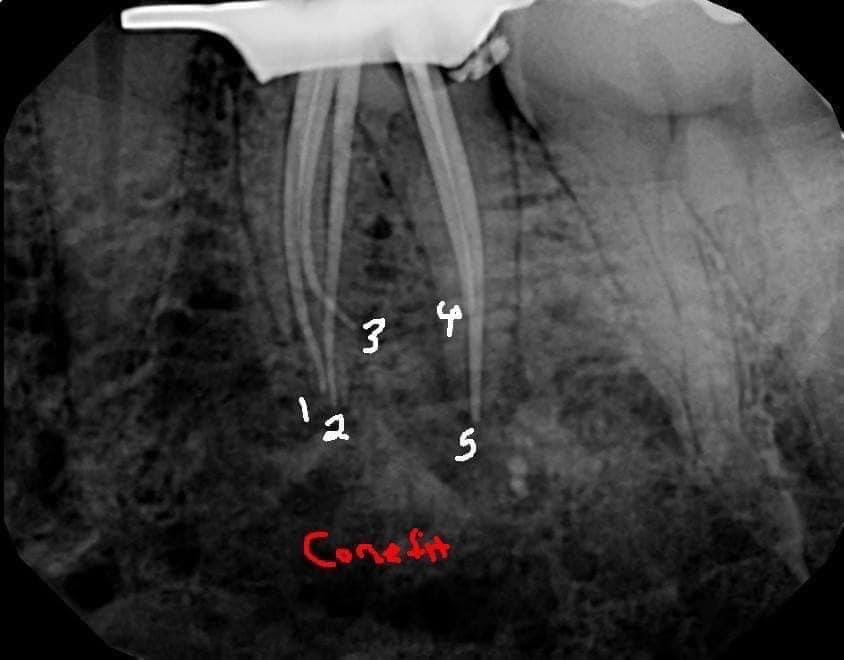 DrRicoShort's tweet photo. Endodontic treatment was done in one visit. There were a total of 5 canals (3 mesials with separate POE's and 2 distals that joined). A 6 month recall shows nice healing and patient was asymptomatic. The restorative dentist did a nice job with the crown.
#LifeIsBetterWithTeeth https://t.co/5skSTC334N