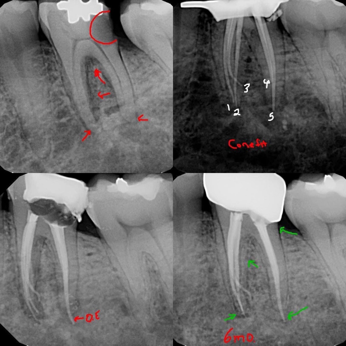 DrRicoShort's tweet photo. Endodontic treatment was done in one visit. There were a total of 5 canals (3 mesials with separate POE's and 2 distals that joined). A 6 month recall shows nice healing and patient was asymptomatic. The restorative dentist did a nice job with the crown.
#LifeIsBetterWithTeeth https://t.co/5skSTC334N