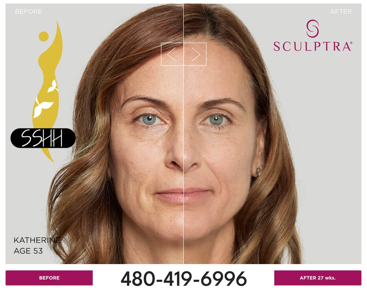 thesshh.com/services/sculp…

BOOK NOW: 480-419-6996

#Sculptra #Wrinkles #FineLines #WrinkleRemoval #Skincare #FacialTreatment