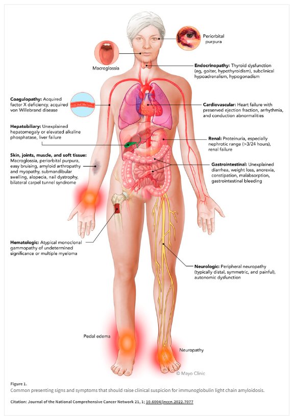 aVoice4ALS's tweet photo. One of best graphics of symptoms of #Amyloidosis often overlooked.
Mom had #macroglossia, alopecia, bilateral #carpaltunnel, PN, #thyroid dysfunction & fatigue. Took 10 yrs for a dx. Died 7 months later.
Now my Aunt has it too 😞
#orthotwitter #Cardiotwitter #Neurotwitter https://t.co/ZL7RrkmsSu