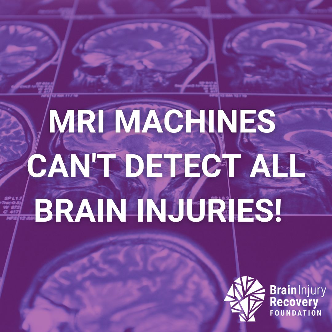 Did you know that 80% of all brain injuries are not visible on conventional MRI or CT scans? Being informed of your symptoms causes is crucial. #NeuroInjury #TBI #TraumaticBrainInjury #BrainInjury #Stroke #concussion #BrainInjurySupport #BrainInjury #MRI #MRIMachine #BrainImaging