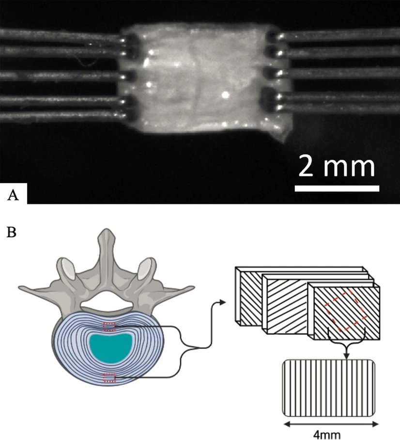 PhysioMeScience's tweet image. Combined flexion and compression negatively impact the mechanical integrity of the annulus fibrosus

link.springer.com/article/10.100…
