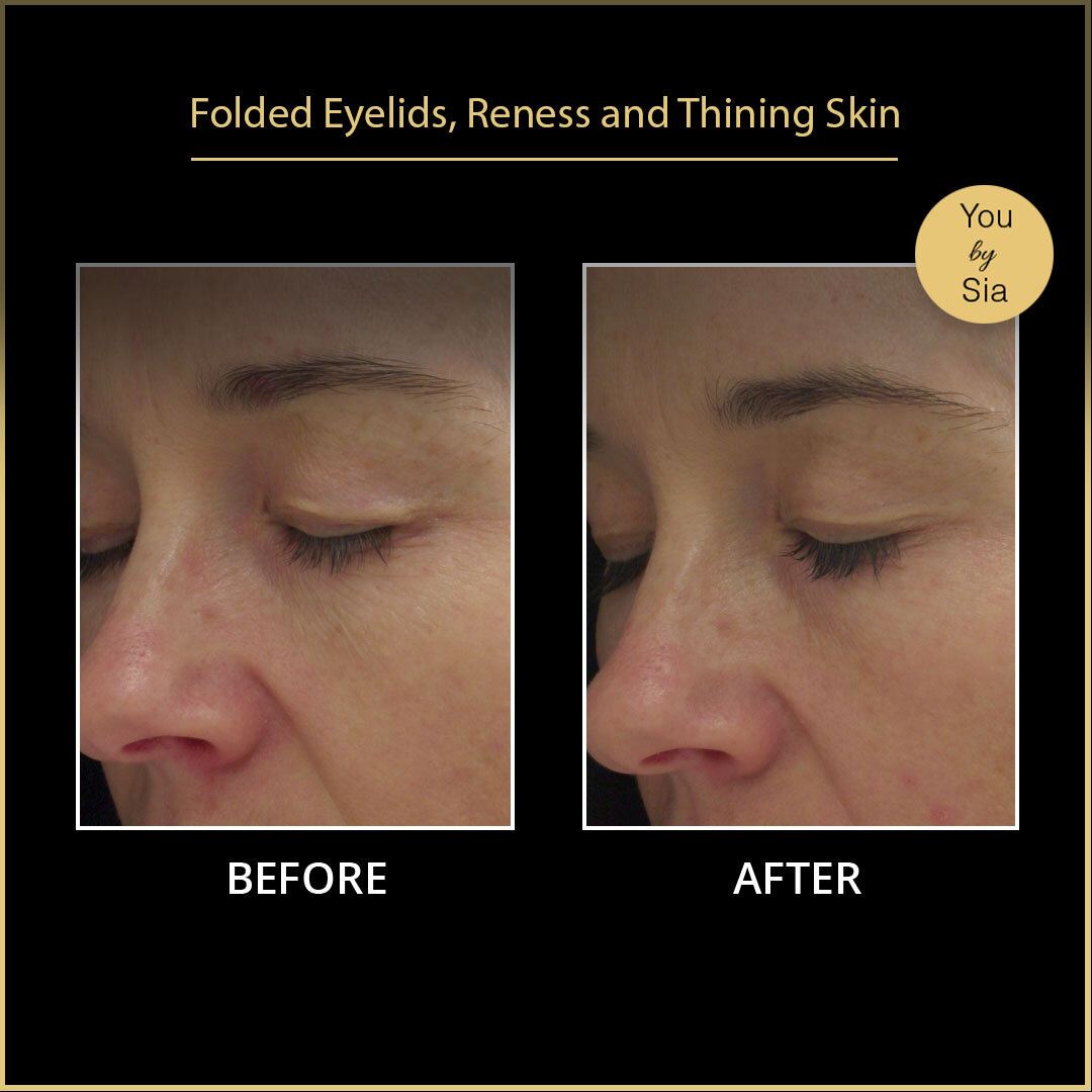 YouBySia's tweet image. The client suffered with folded eyelids. But with the help of our Thermique Treatment, the client acheived beautiful results. Skin is firmer, lifted and more plump.

Call us at (02)83237510 to book your appointments

#clinicals #clenz #firmerskin #release #shiftam