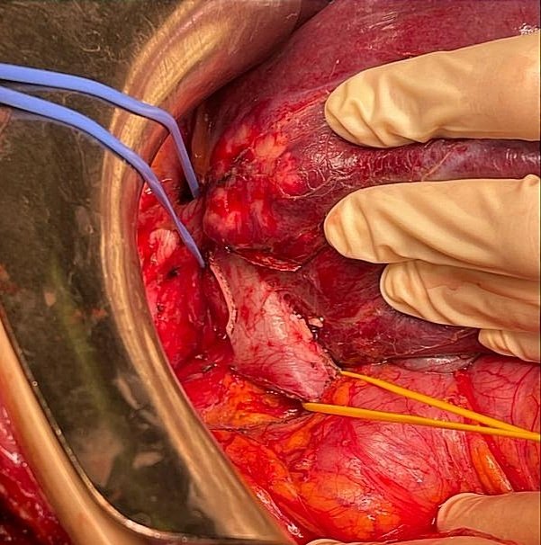 RositaDeVin's tweet photo. What a great way to start the weekend!

67yo F, stenotic transverse colon cancer and synchronous hepatic metastases, one of which in close contact with RHV at confluence.
🔪 Multiple wedge resections and extended right hemicolectomy.
SHVE &amp; Pringle maneuver ✔️
#liversurgery #hpb https://t.co/zN7ScFBuVF