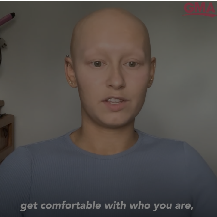 Dani Gilbert strips down to bald and inspires women with alopecia areata to celebrate their beauty. abcnews.go.com/GMA/Style/vide… #Alopecia #alopeciaareata #baldbeauty #alopeciauniversalis #baldgirlsdolunch