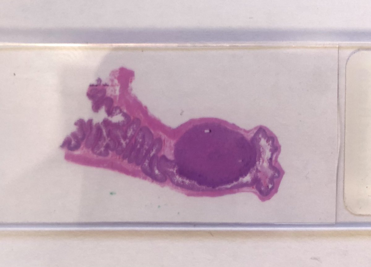 #LPPath #Surgpath #Pathresidents #Pathtwitter

An adult patient of indeterminate age presented to a hospital for a surgery to remove a portion of his/her body.

#Pathresidents/anyone:  Diagnosis?