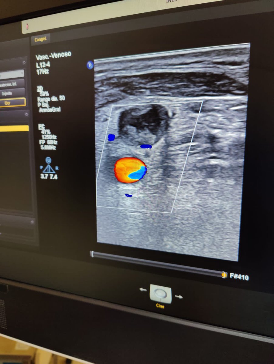 MarkOO7S's tweet photo. La evaluación vascular previa punción es importante; ejemplo de vena yugular derecha con trombosis por catéter previo. Se coloca femoral sin complicaciones. @NefrologiaINER @nefrointerpocus @sengndi https://t.co/aIao4559uM