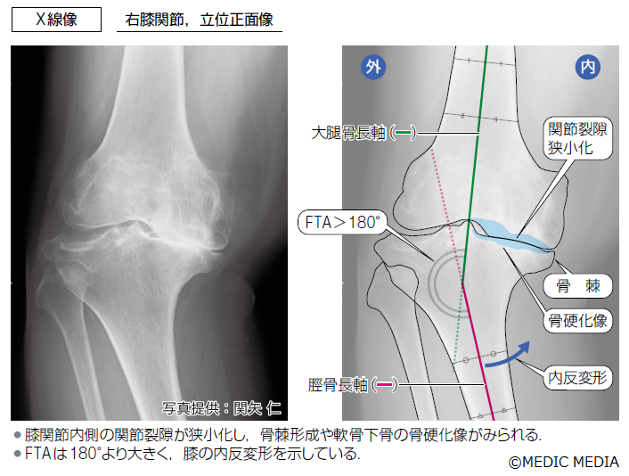 変形性膝関節症のX線像】変形性膝関節症の診断にはX線検査が必要である
