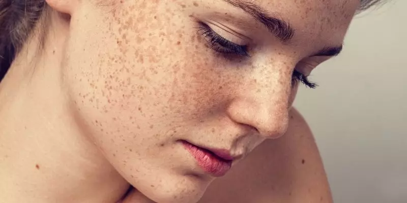 asanbull's tweet photo. Freckles are beautiful. https://t.co/MKDVSJXB5z
