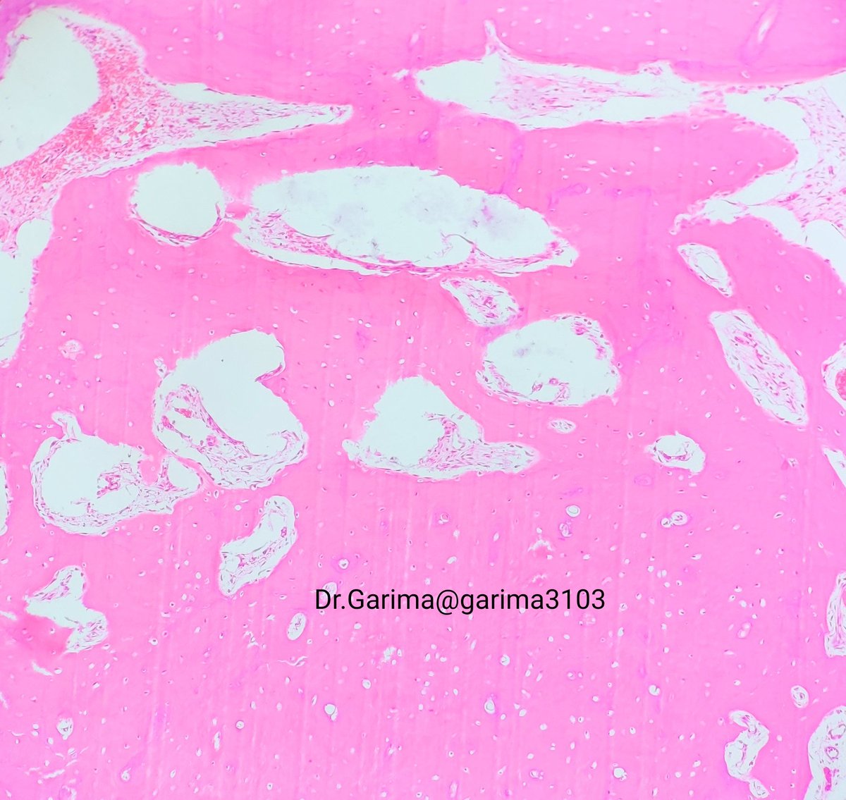 Garima3103's tweet photo. 27/F with hard swelling near inferior border of mandible on external surface.. Overlying skin is normal
Lets discuss some bone pathologies!
#PathTwitter #bonepathology https://t.co/TIGrU7Lg23
