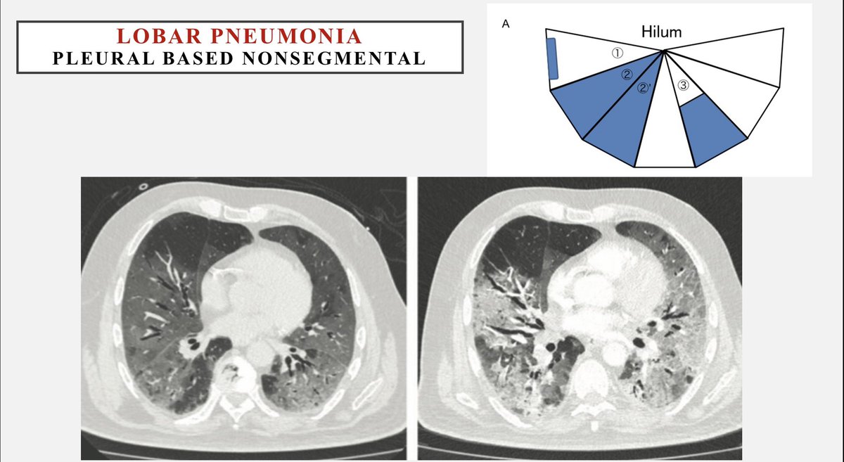 khaledzeid's tweet photo. Multilobar pneumonia vs bronchopneumonia. Lobar pneumonia begins by filling alveoli at supleural space &amp; spread between segments through interalveolar pores > appears pleural based, non segmental &amp; progress to hilum. If subpleural space, spared still peripheral &amp; nonsegmental 1/2 https://t.co/RnTSDas5TZ