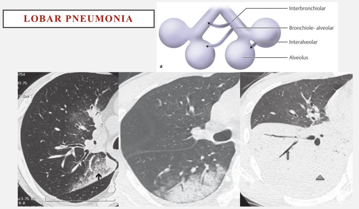 khaledzeid's tweet photo. Multilobar pneumonia vs bronchopneumonia. Lobar pneumonia begins by filling alveoli at supleural space &amp; spread between segments through interalveolar pores > appears pleural based, non segmental &amp; progress to hilum. If subpleural space, spared still peripheral &amp; nonsegmental 1/2 https://t.co/RnTSDas5TZ