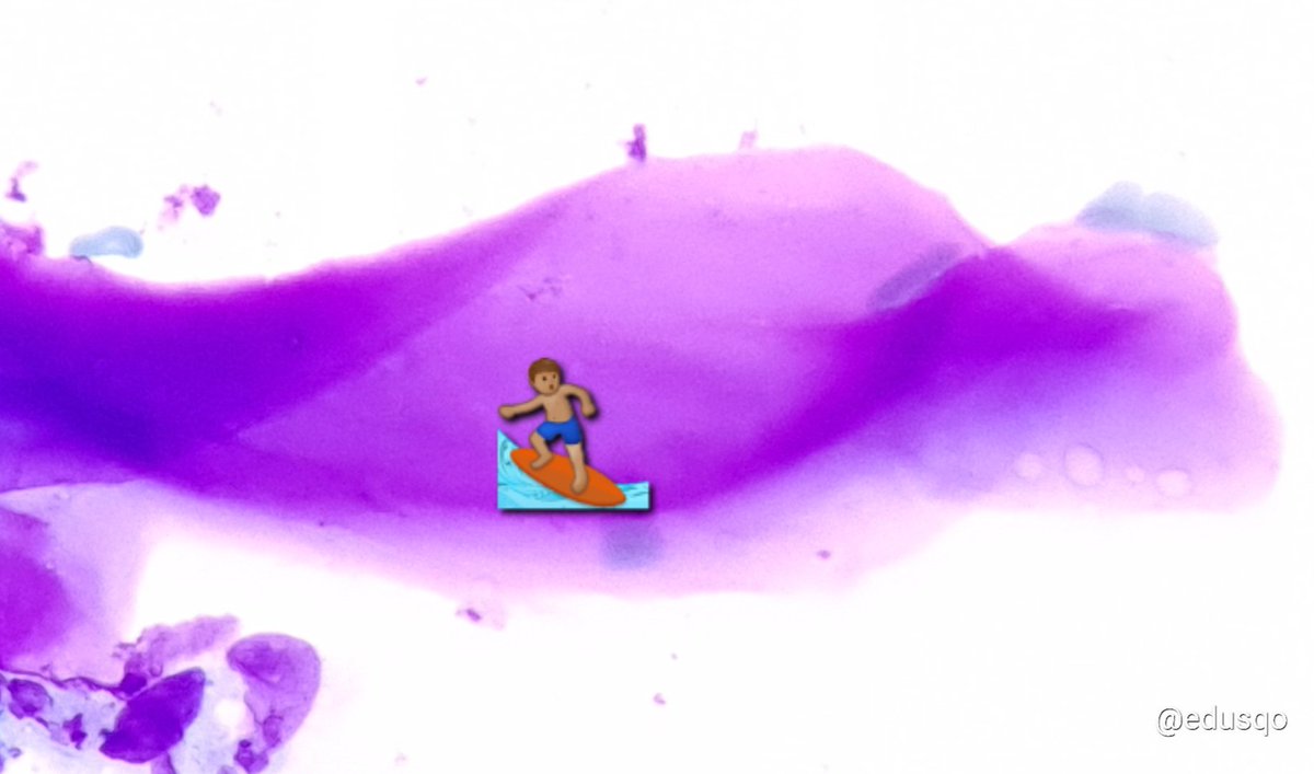 edusqo's tweet photo. Just enjoying this stroma from a soft tissue (benign tumor), probably a schwannoma.
What can I say? I am a pathologist 😅
#FNAFriday #CytoPath #Myxoid #Hyaline #BSTPath https://t.co/q3NprpYvft