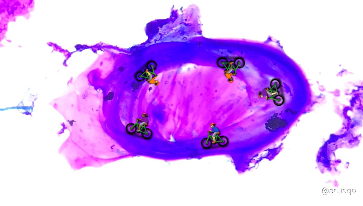 edusqo's tweet photo. Just enjoying this stroma from a soft tissue (benign tumor), probably a schwannoma.
What can I say? I am a pathologist 😅
#FNAFriday #CytoPath #Myxoid #Hyaline #BSTPath https://t.co/q3NprpYvft