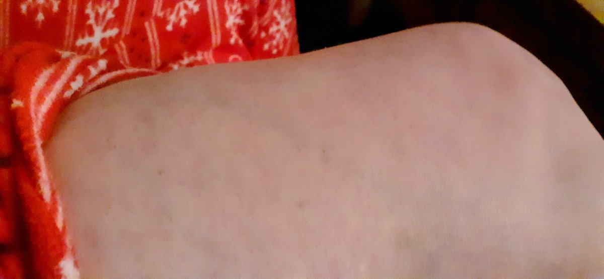 Ann98897110's tweet photo. So it seems they are hitting the femoral vein , will cause  thrombosis,  circulatory circulation. https://t.co/JtqLLs7sHr